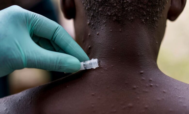 monkey pox: learn what a global health emergency is, what precautions must be taken, etc.
