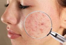 Top 10 Best Acne Care Brands in India in 2027