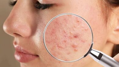 Top 10 Best Acne Care Brands in India in 2027