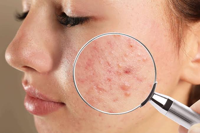 Top 10 Best Acne Care Brands in India in 2027